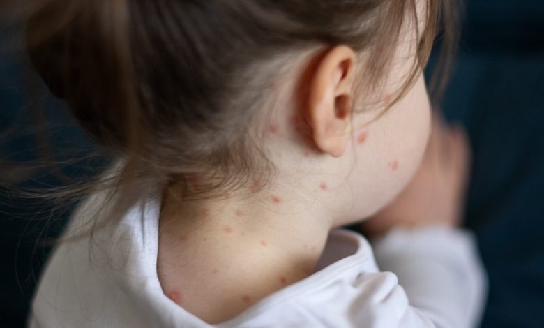 Child with measles