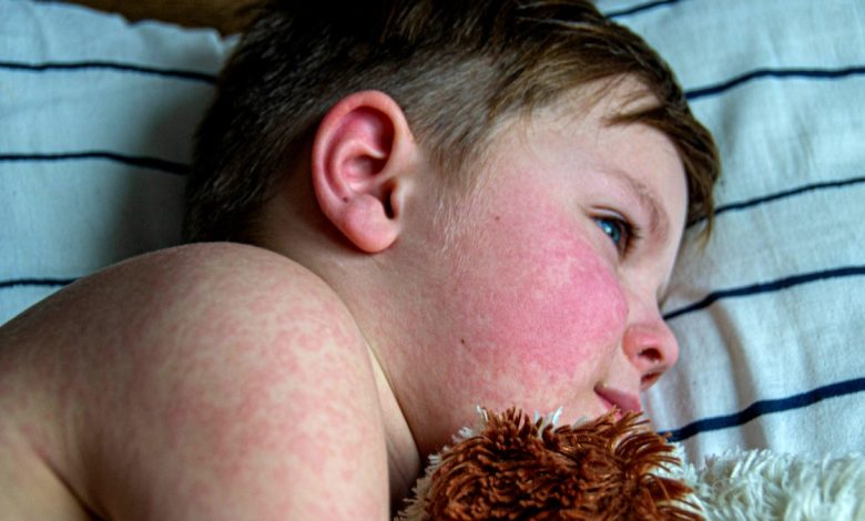 Child with flushed cheek rash