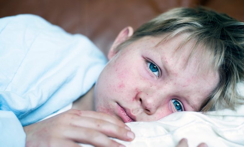 sick little boy fighting measles infection