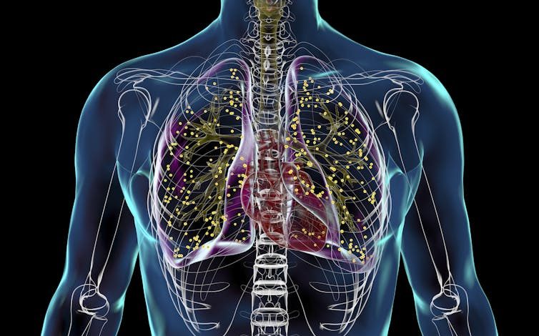 This illustration shows a TB infection in the lungs of a patient.