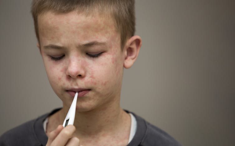 A young boy with measles holds a thermometer in his mouth