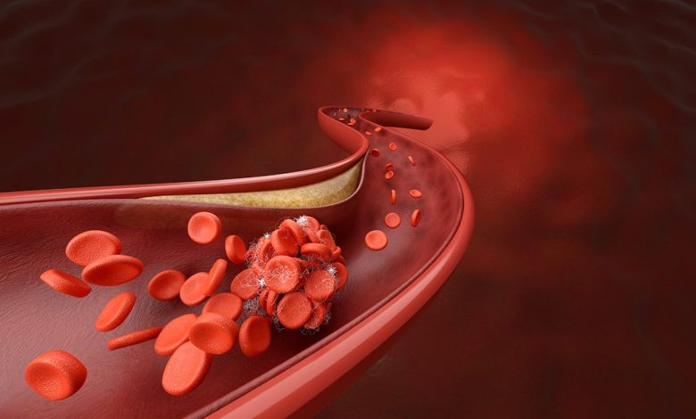 coronary artery and blood clot disease, Blood cell blocked by cholesterol or fat metaphor hyperlipidemia and embolic stroke. 3D rendering.
