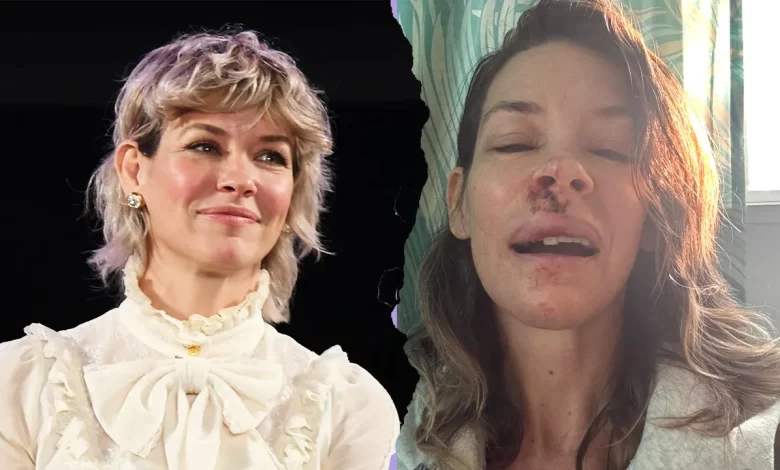 Evangeline Lilly shares photos of injuries after beach blackout incident