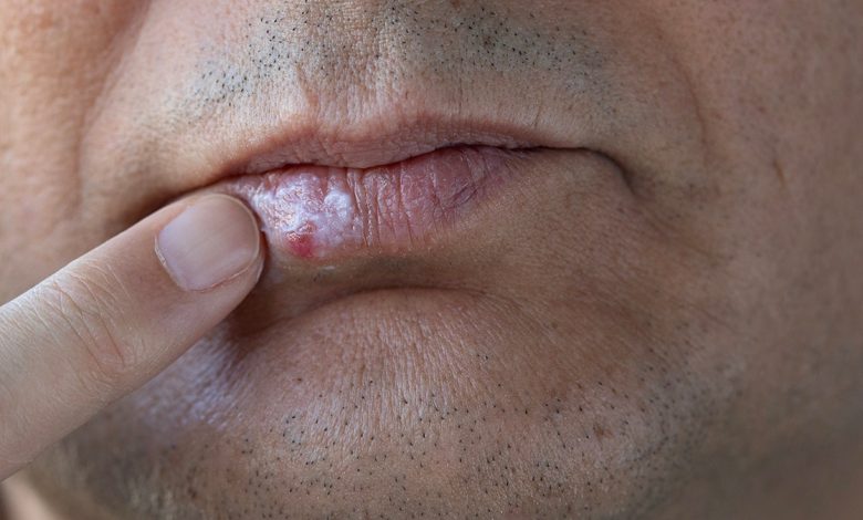 Man with cold sore (only mouth pictured) applying cream to his lips.