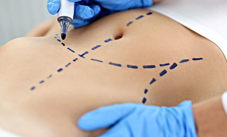 plastic surgeon drawing preoperative markings on skin of patient's abdomen