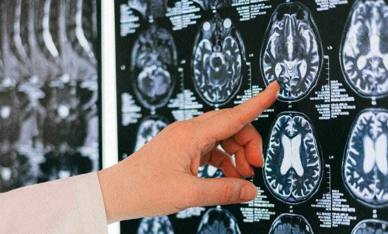 AI brain scan tool predicts how fast you are aging